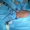 Кому нельзя делать эпидуральную анестезию Чем опасна эпидуральная анестезия при операциях
