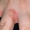Redness and itching on the hands than to treat