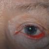 Dry eyes - causes and treatment Why does dry eyes happen