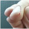 Cracks on the hands, fingers: causes and treatment