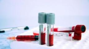 Insulin resistance diagnostics, HOMA and caro indices