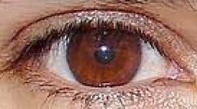 What is the name of the disease when people have different colored eyes