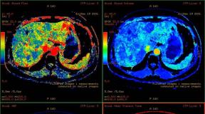 MRI medeničnih organov - priprava, značilnosti, kontraindikacije