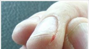 Cracks on the hands, fingers: causes and treatment