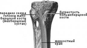 Comminuted fracture of the tibia with displacement: treatment Fracture of the tibia with displacement treatment