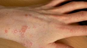 Scabies sick leave.  Scabies.  New conversations about an old ailment How long does itching last after scabies treatment
