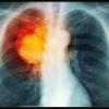 Pljučni rak: etiologija, klasifikacija, klinična slika in zdravljenje. Klinične manifestacije pljučnega raka