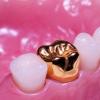 How to put a crown on a tooth - the stages of manufacturing and installing a crown
