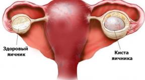 Cyst on the ovary: treatment and symptoms Is the cyst life-threatening?