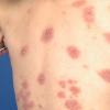 Allergy - rash all over the body