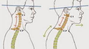 Signs of cervical kyphosis and its treatment