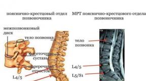 What is a herniated disc and how is it treated?