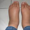 Tumors and folk medicine Folk remedies for swelling of the legs and arms