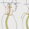 Signs of cervical kyphosis and its treatment