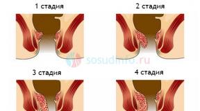 Hemorrhoidectomy - all about the operation Hemorrhoidectomy with restoration of the mucosa