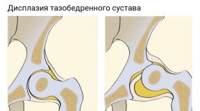 Conservative therapy or surgery: treatment of coxarthrosis of the hip joint Coxarthrosis ICD code 10 in adults