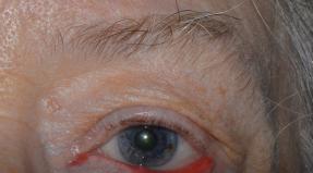 Kuivad silmad – põhjused ja ravi Miks tekivad kuivad silmad