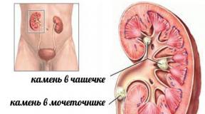 Kidney stone: treatment with folk remedies Kidney stones, folk methods of treatment