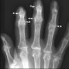 Ossification points on x-rays of bones of people of different ages Bone age according to x-rays