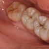 How to treat caries at home