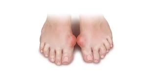 Recommended and harmful foods for gout Is it possible to eat lard for gout