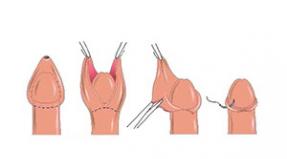 Операция круговое иссечение крайней плоти (циркумцизио) Удаление крайней плоти у мужчин