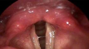 Laringitis: kako zdraviti doma Zdravljenje laringitisa pri odraslih